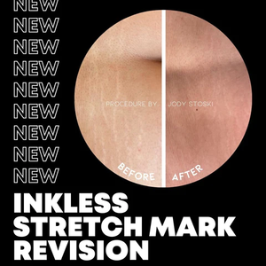 Payment Plan: Inkless Stretchmark Removal : 1 Area